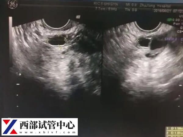 監測排卵可以找到排卵期